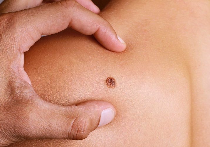 Будьте аккуратны с родинками и наблюдайте за ними