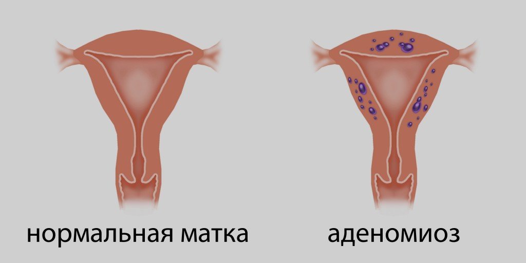 Аденомиоз
