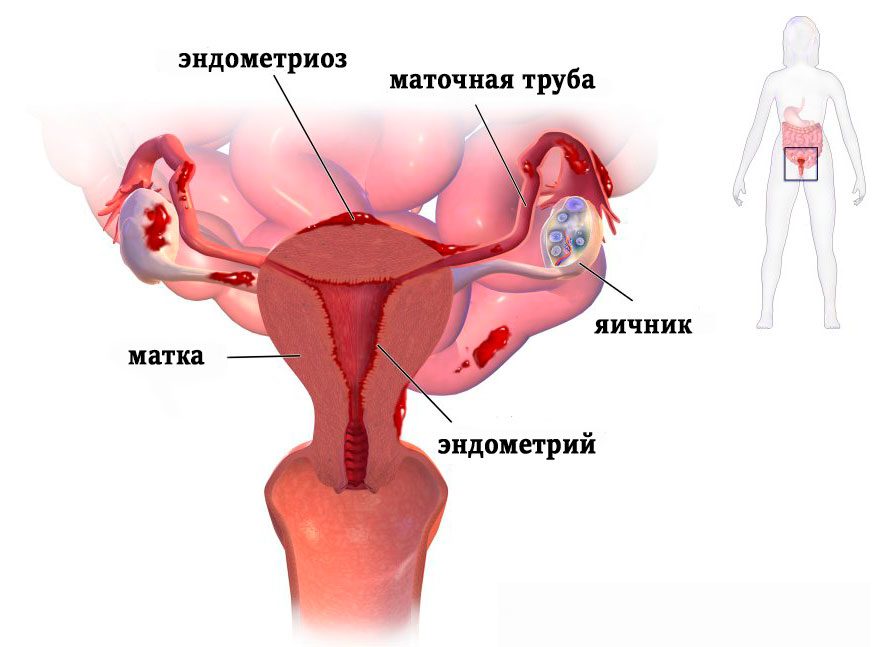 Эндометриоз