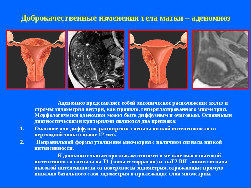 Аденомиоз