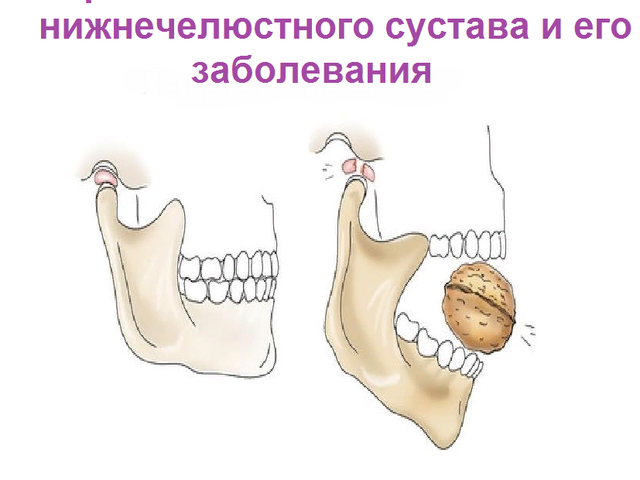 Височно-нижнечелюстной сустав: строение, анатомия, кровоснабжение, иннервация, движения, мышцы, кости, суставные поверхности, диск, капсула, классификация, функциональные особенности, характеристика. Заболевания ВНЧС, виды диагностики: синдром болевой дисфункции, симптомы, артроз, артрит, МРТ, лечение, вывих, подвывих, рентген, воспаления, анкилоз, балансировка, врач, который лечит