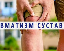 Ревматизм суставов: причины, симптомы и лечение. Как и чем лечат ревматизм суставов: препараты, народные методы