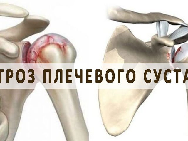 Артроз плечевого сустава: симптомы и лечение, профилактика. Как и чем лечить артроз плечевого сустава: список препаратов, медикаментозное лечение, гимнастика