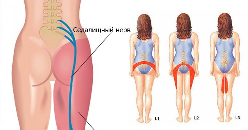 Места боли при защемлении