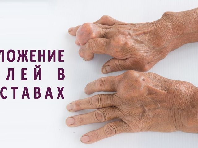 Почему соли откладываются в суставах — медикаментозное лечение, спасение с помощью народной медицины: выведение лишних солей из суставов