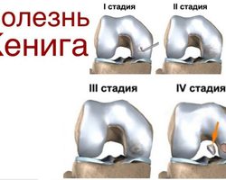 Болезнь Кенига коленного сустава: причины, стадии заболевания, проявления и симптомы, диагностика, лечение