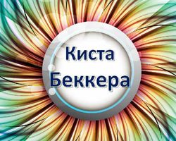 Киста Беккера коленного сустава: причины появления, симптомы, диагностика, лечение медикаментозное и народными методами, профилактика, упражнения