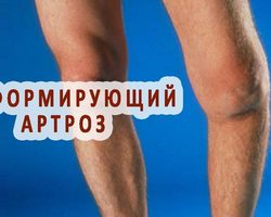 Деформирующий артроз коленного сустава: симптомы, причины, методы медикаментозного лечения. Что такое деформирующий артроз коленного сустава?