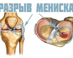 Что такое мениск коленного сустава? Разрыв мениска коленного сустава: причины, симптомы, лечение