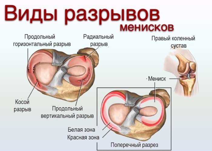 Мениск. разрыв