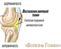 Болезнь Гоффа: причины, симптомы, диагностика, лечение, профилактика заболевания
