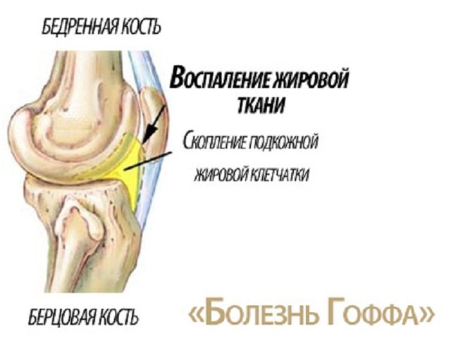 Болезнь Гоффа: причины, симптомы, диагностика, лечение, профилактика заболевания