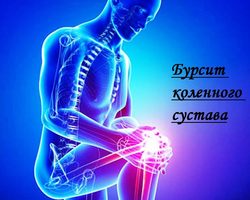 Почему появляется бурсит? Разновидности бурсита. Основные методы лечения бурсита в официальной медицине. Народные средства для борьбы с бурситом