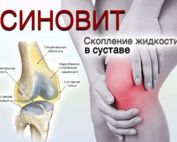 Как бороться с жидкостью в коленных суставах, почему в коленях появляется лишняя жидкость, как избавиться от жидкости в суставах: медикаментозные методы и рецепты народной медицины