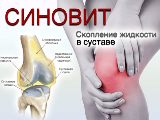 Как бороться с жидкостью в коленных суставах, почему в коленях появляется лишняя жидкость, как избавиться от жидкости в суставах: медикаментозные методы и рецепты народной медицины