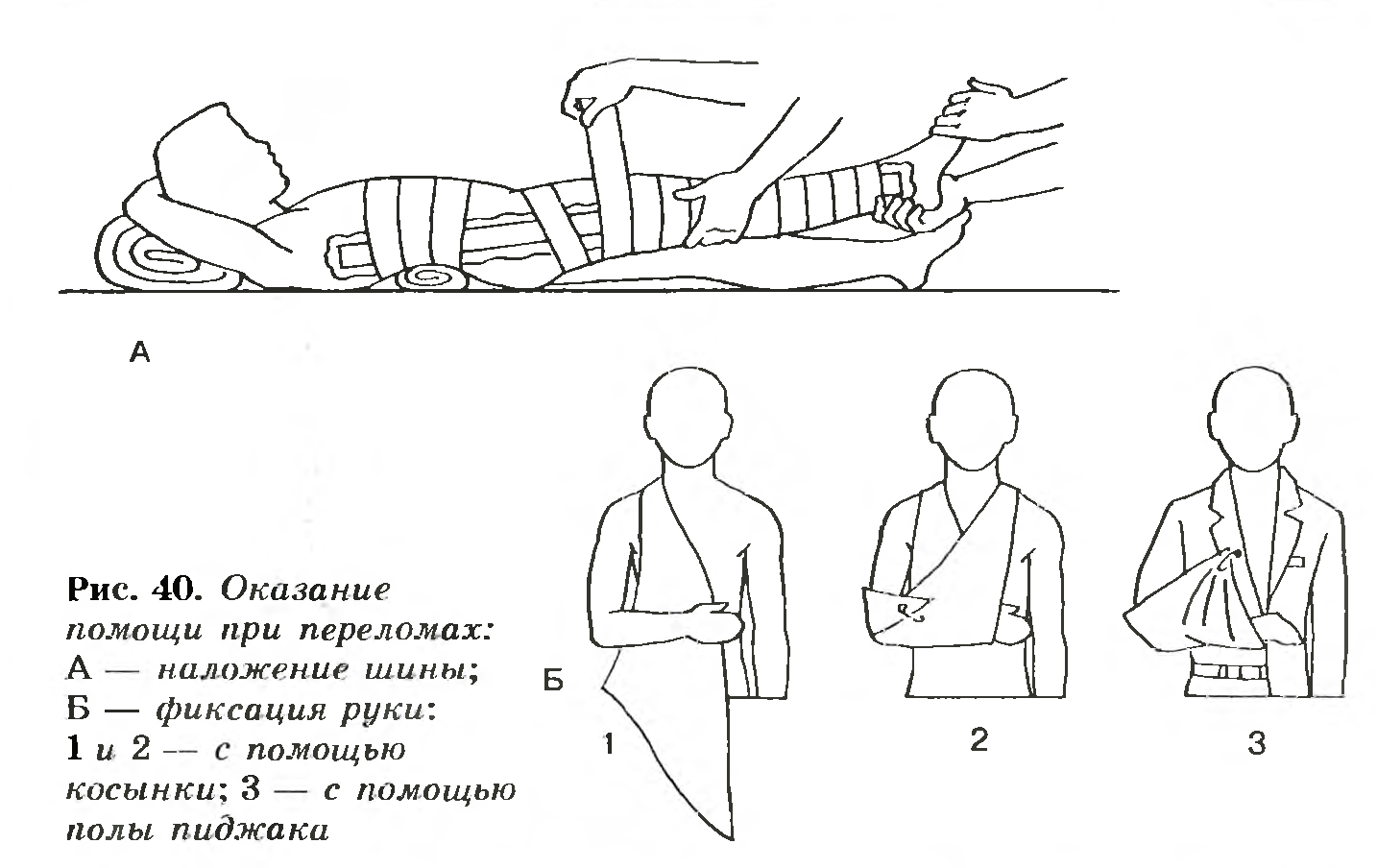 Перелом бедра