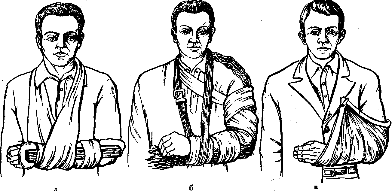 Перелом руки