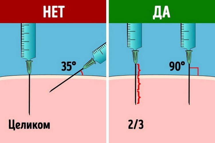 Как правильно ввести иглу при внутримышечной инъекции?