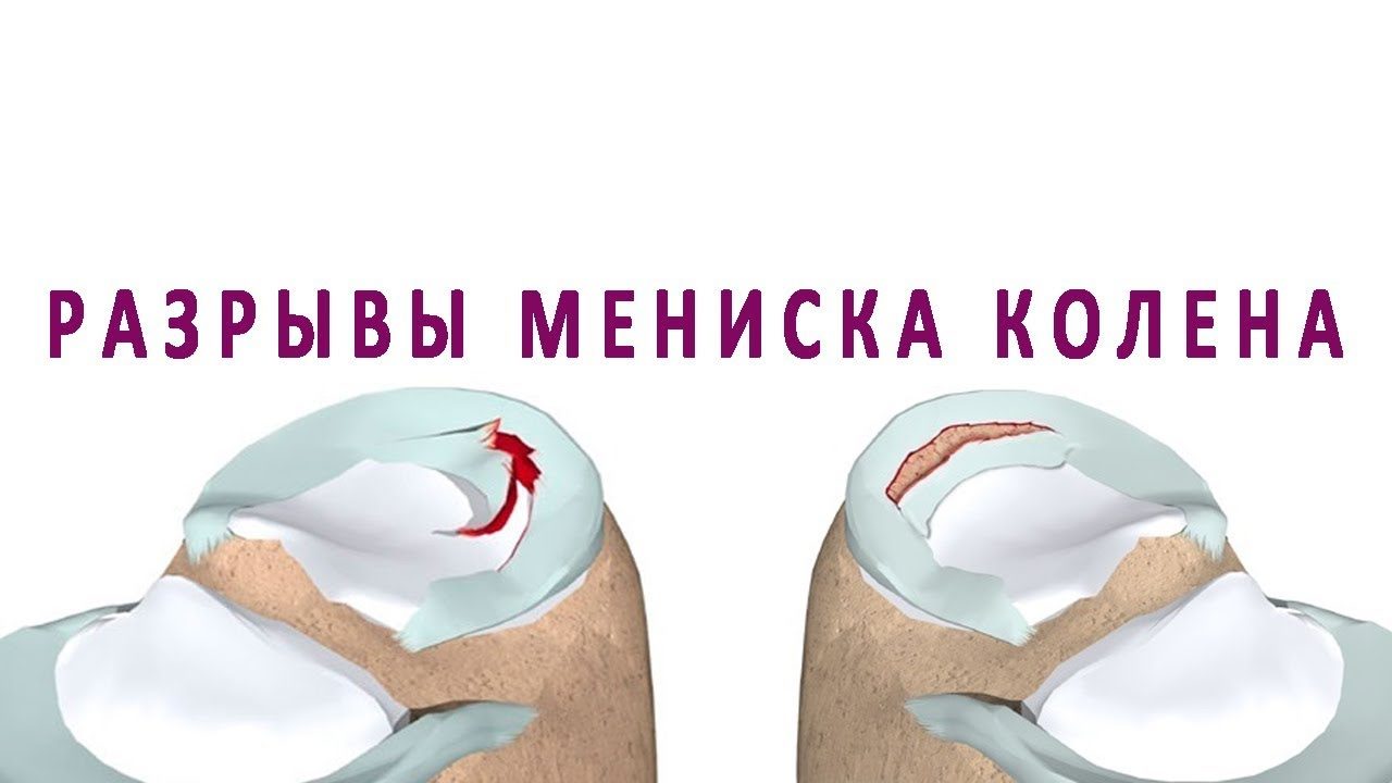 Разрыв мениска колена