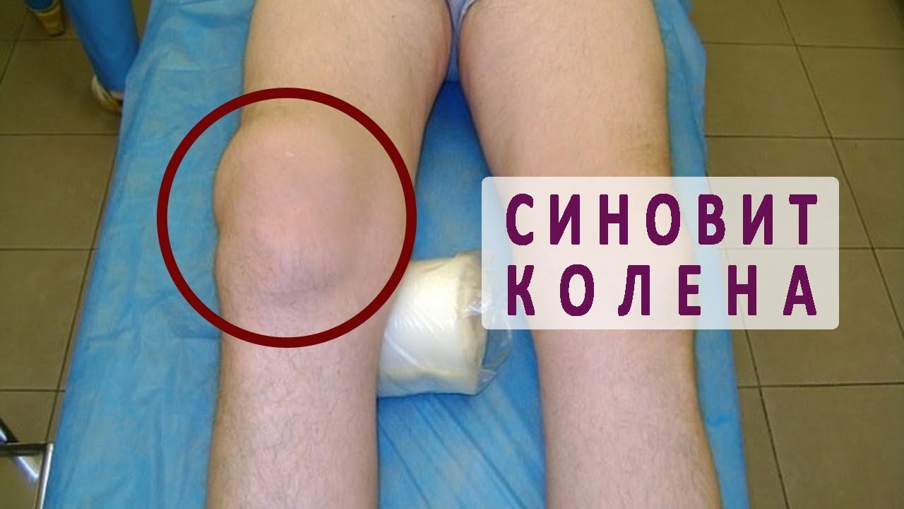 Синовит (выпот)