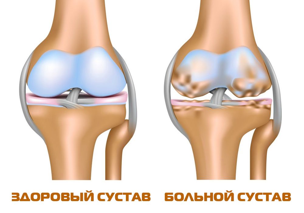 Остеоартроз