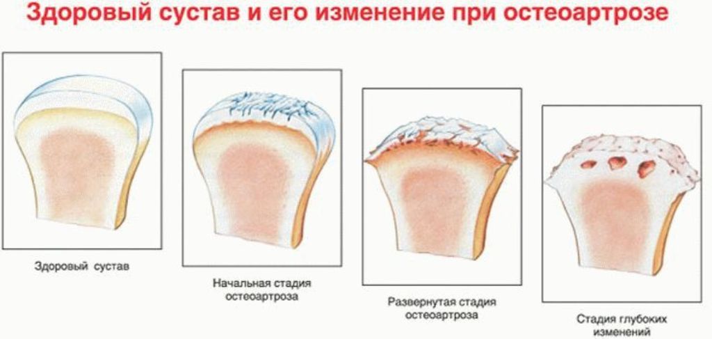 Схема развития недуга