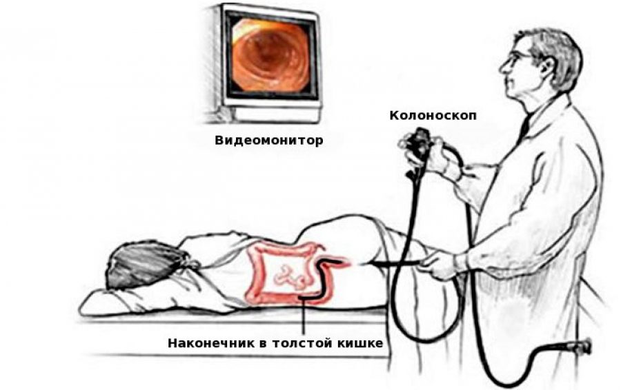 Схема колоноскопии