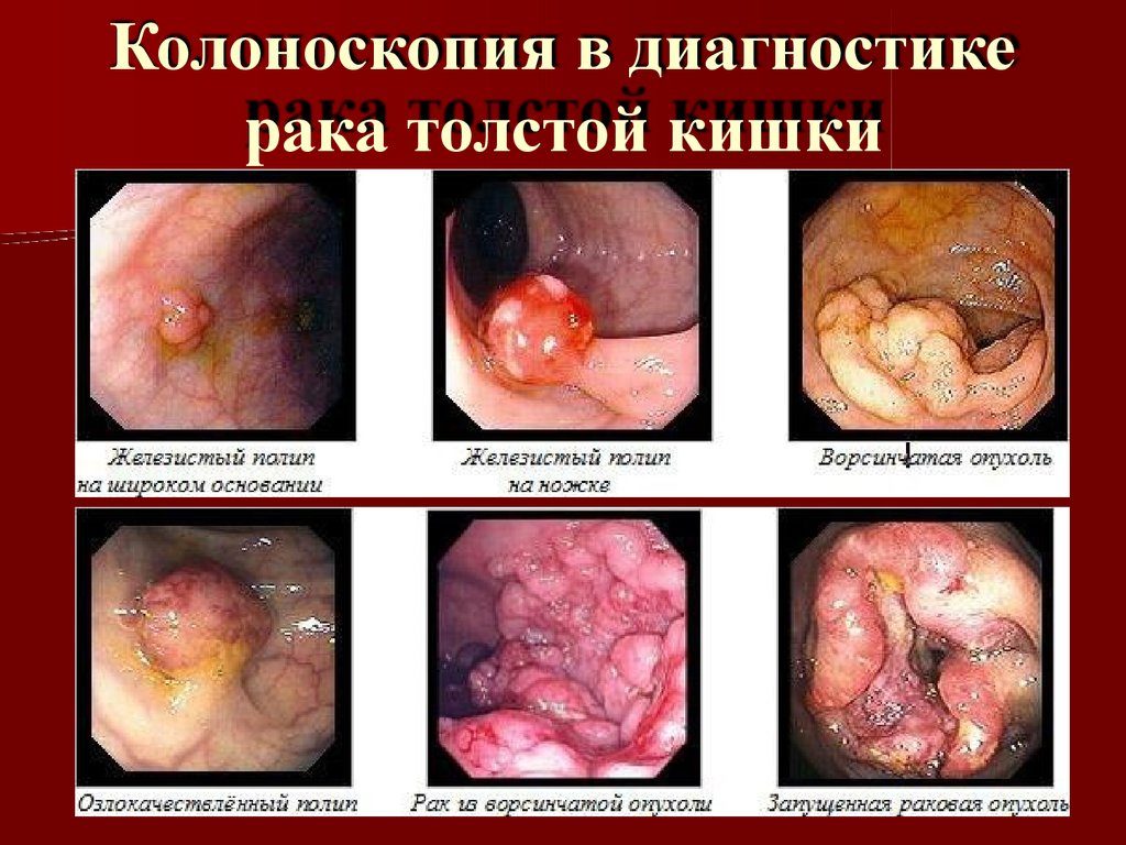 Диагностика рака