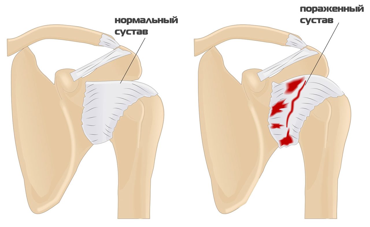 Схема возникновения недуга