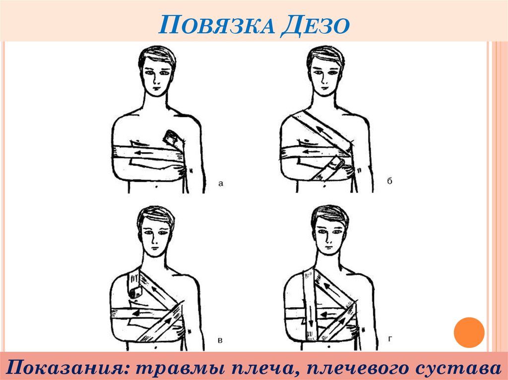 Схема повязки
