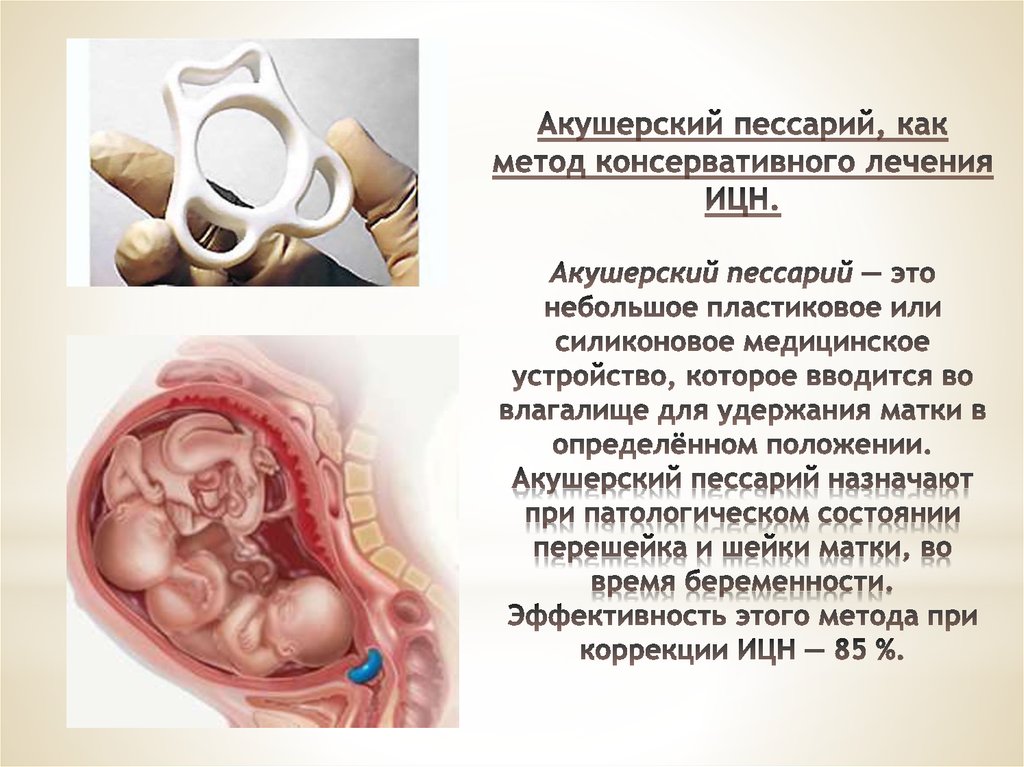 Пессарий