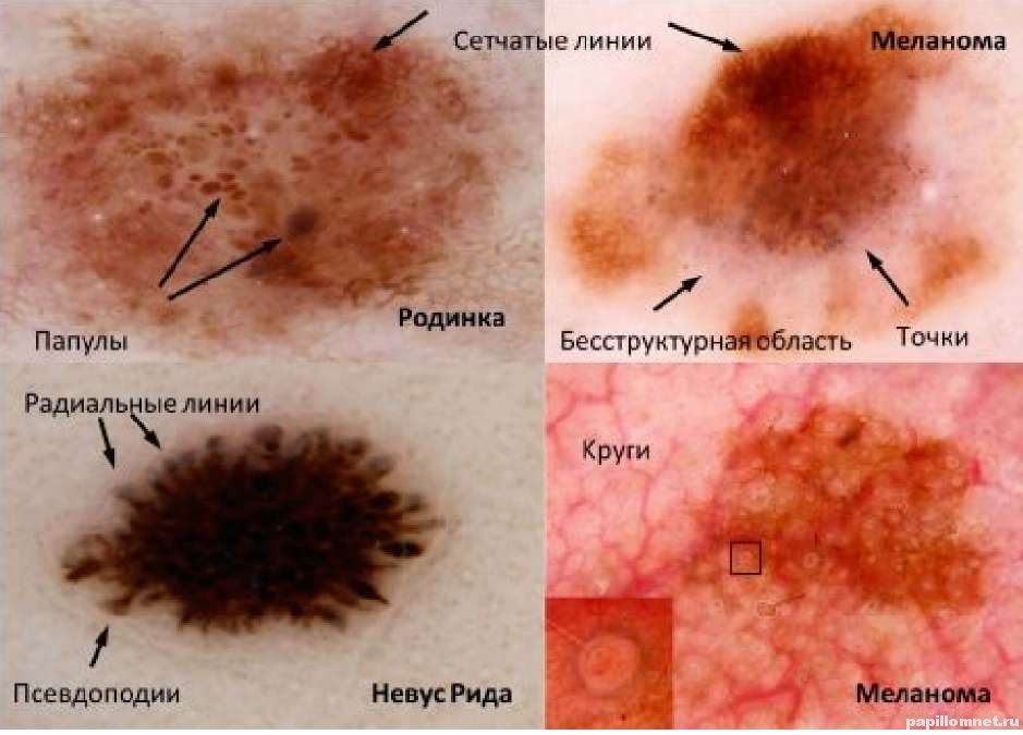 Меланома