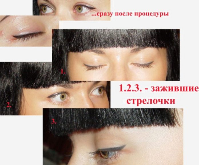 Заживление