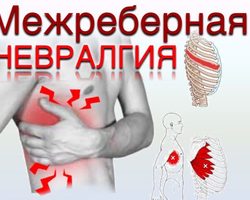 Межреберная невралгия: признаки, симптомы, лечение, профилактика