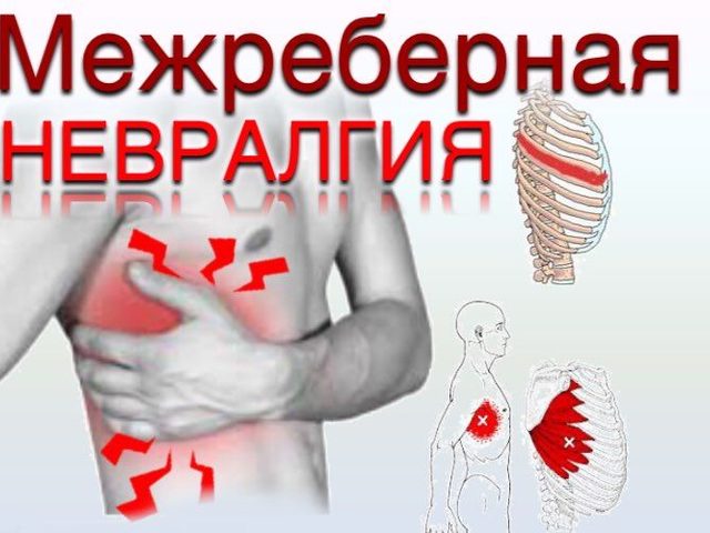Межреберная невралгия: признаки, симптомы, лечение, профилактика