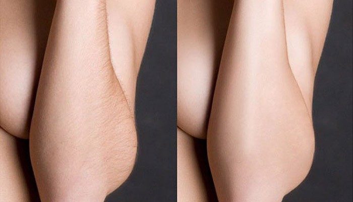 Фотоэпиляция - результат