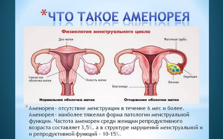 Аменорея у женщин
