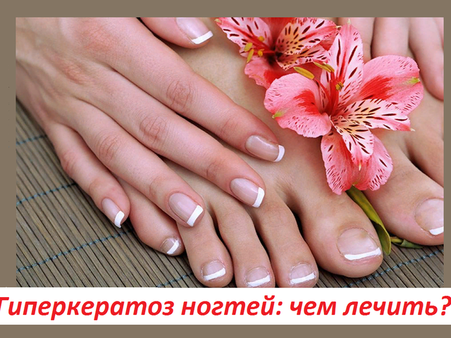 Чем лечить гиперкератоз ногтей на руках и ногах: причины, признаки, формы, фото, отзывы. Чем лечить выраженный подногтевой гиперкератоз на руках и ногах при онихомикозе?