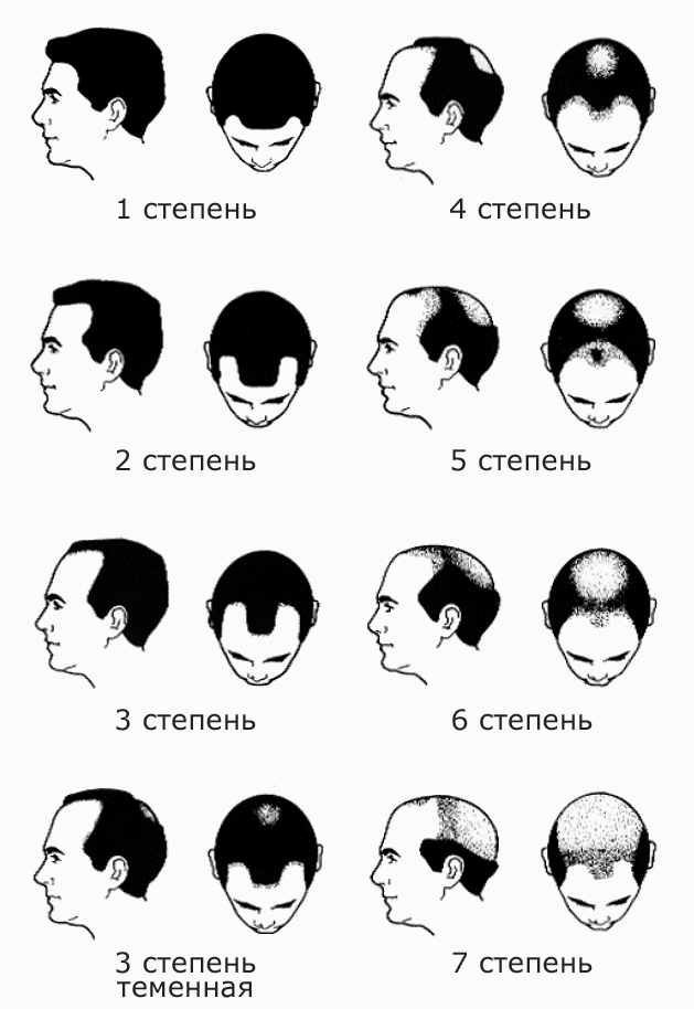 Степени облысения
