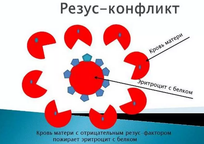 Резус-конфликт при беременности