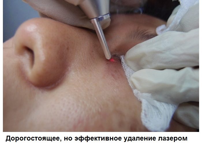Удалять их можно только после консультации с врачом!