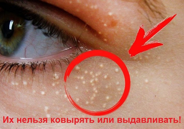 А уж тем более запрещено их вскрывать иголкой дома!