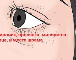 Жировик, просянка, милиум или белые прыщи на лице, в месте шрама: причины возникновения, народные средства лечения, меры профилактики