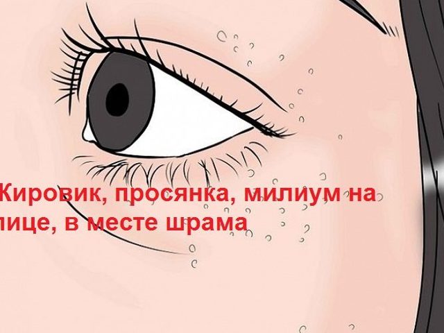 Жировик, просянка, милиум или белые прыщи на лице, в месте шрама: причины возникновения, народные средства лечения, меры профилактики