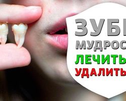 Нужно ли и опасно ли удалять зуб мудрости? Удаление зуба мудрости: показания и противопоказания