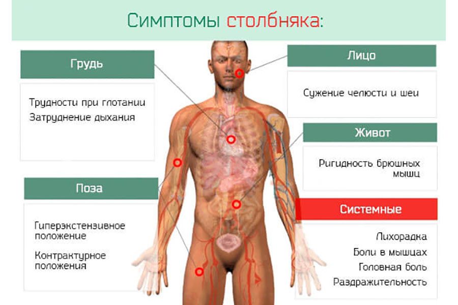 Изображение 3. основные симптомы столбняка.