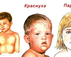 Прививка от кори, краснухи, паротита: правила проведения, когда и сколько раз в жизни делают детям?