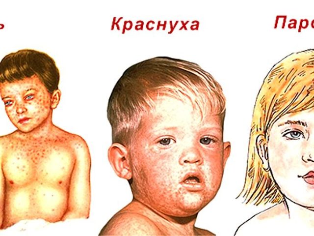 Прививка от кори, краснухи, паротита: правила проведения, когда и сколько раз в жизни делают детям?