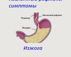 Кислотный рефлюкс — изжога: симптомы. Какие продукты нельзя есть при кислотном рефлюксе: список, советы, рекомендации