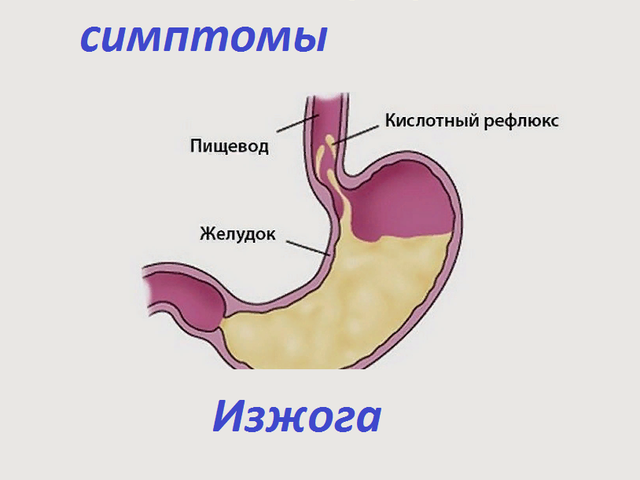 Кислотный рефлюкс — изжога: симптомы. Какие продукты нельзя есть при кислотном рефлюксе: список, советы, рекомендации